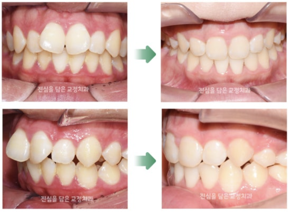 나비치아 교정을 통해 돌출입을 개선한 사례